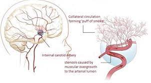 Moyamoya Disease A Rare Vascular Disease Of The Cns Intechopen