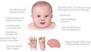 Down syndrome is a chromosomal disorder. Managing Down Syndrome Tips To Improve The Quality Of Life Punekar News
