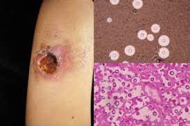 Médica dermatóloga, universidad del valle, cali, colombia 2. Afectacion Cutanea En Las Micosis Profundas Una Revision De La Literatura Parte 2 Micosis Sistemicas Sciencedirect