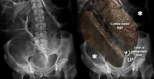 Image result for Sigmoid Volvulus