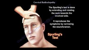 Image result for Spurling Sign