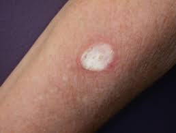 A few weeks ago, i burned the top of my hand while cooking. Cryotherapy Dermnet Nz