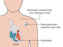 Image result for Internal Cardiac Defibrillator