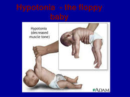 Image result for Floppy Infant