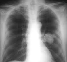Chest Radiology