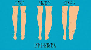 lymph nodes are part of the body's immune system that work as filters for harmful substances. Skin Cancer Complications How It Affects Your Body Everyday Health