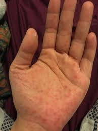 Penderita hfmd bisa jadi tidak menunjukkan penyakit ini terutama menyebar melalui kontak dengan cairan hidung atau tenggorokan, air liur, cairan luka atau feses orang yang terinfeksi. Hey Remaja Pun Masih Boleh Dijangkiti Hfmd Seperti Gadis Ini Remaja
