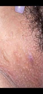 What do i do if i have genital herpes? Is This An Ingrown Hair Or A Herpes Outbreak Genital Herpes Simplex Forums Patient