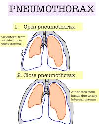 Image result for Open Pneumothorax