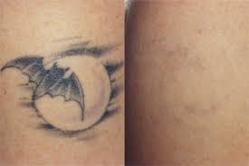 This content is imported from instagram. Tattoo Removal Washington Dc Center For Laser Surgery