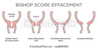 The bishop or cervix score, predicts vaginal birth with medical induction. Medical Illustration Diagram Bishop Score Effacement Levels Medical Illustration Diagram W Bishop Score Effacement Levels Canstock