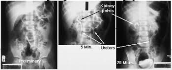 Image result for Intravenous Pyelogram