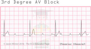 We did not find results for: 3rd Degree Av Block Complete Heart Block Clinical Grepmed