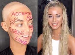 This Model Is Embracing Her Alopecia And Showing Off An Amazing Wig In The Process Alopecia Hairstyles Hairstyles For Alopecia For Women Alopecia Wig