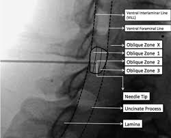 Image result for Lower Cervical Intramuscular Injection