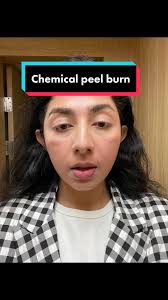 Got severe chemical burn after chemical peel 😭 will keep you guys updated 