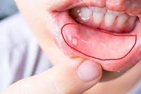 Wenn nicht bitte verschieben, danke. Normal Dass Lippe Innen Uneben Ist Gesundheit Und Medizin Mundschleimhaut