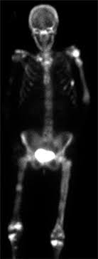 When it does occur, signs and symptoms of bone metastasis include: Metastatic Bone Disease Uconn Musculoskeletal Institute
