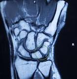 Image result for icd 10 code for scapholunate dissociation of right wrist