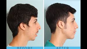 See full list on wikihow.com How To Get A Good Jawline And Cheekbones Part 2 Youtube