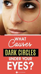 What Causes Dark Circles Under Your Eyes In 2020 Dark Circles Around Eyes Dark Circles Under Eyes Dark Rings Under Eyes
