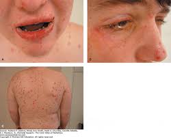 Image result for Erythema Multiforme Major