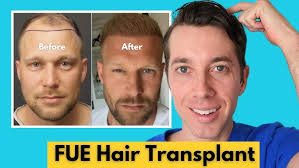 Why Do So Many Hair Loss Clients Choose Hair Transplants of Florida?