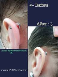Pin On Acne On Nose