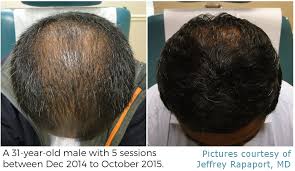Our hair is often one of the first things we notice about a person, it frames our face and can say a lot about our personal style. Learn About Prp Therapy Hair Restoration In Spring Tx 832 702 8418 Prp For Hair Loss In Spring Houston The Woodlands