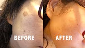 Before And After Black And White Bleaching Cream Reviews Amaira Intimate Lightening Serum Review Does It Really Work Lightening Serum Dry Skin Body Skin Lightening Cream