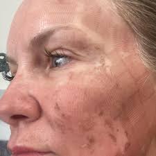 Michelle Huseman RN (@michellehuseman_aestheticsrn) • Instagram photos and  videos