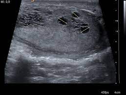 It is usually seen in vasectomy patients presenting with scrotal discomfort, however, other causes of vas obstruction also lead to similar sonographic changes. Tubular Ectasia Of Rete Testes Pacs Entwicklung