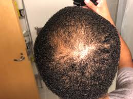 Balding 360 crown waves is when the hair waves on top of the head start to fall out. What Are Your Secrets Recommendations I Am Balding At Hair Crown And Some Thinning At The Top How Can I Get It To Grow Back I Am Only 23 And I Will Like