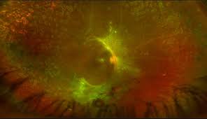 Image result for Retinal Detachment