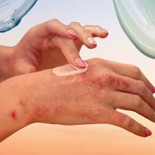 Image result for psoriasis