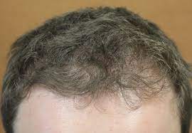 Minoxidil Does It Help With Hair Loss In The Front Or Top Or Both Donovan Hair Clinic