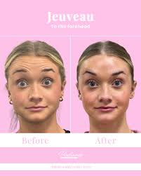 ✨ Full-Face Jeuveau for Natural, Confident Results ✨ Meet Brinkley, our  talented new aesthetician at Radiance. While she's had a lip flip before,  this was her first time experiencing full-face Jeuveau—and the