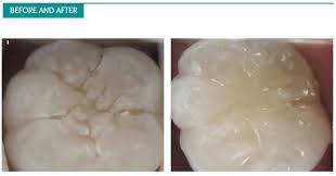 Before acid etching to improve sealant retention57. Preventative Care All In The Family Dental Evansville In