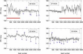 Image result for FHR Variability