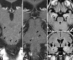 .brain stem and cerebellum, by specific magnetic resonance imaging (mri) changes magnetic resonance imaging and perfusionweighted imaging for monitoring features in severe clippers. Chronic Lymphocytic Inflammation With Pontine Perivascular Enhancement Responsive To Steroids And Human Leukocyte Antigen
