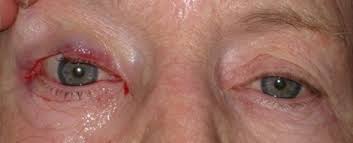 It is most effective on the two most common skin cancers, basal cell carcinoma and squamous cell carcinoma. Eyelid Basal Cell Carcinoma Before And After Photos Boston Eyelids