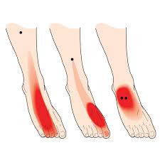 Serious sport foot pain is achilles tendinitis. Pin On Fit Inspiration