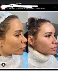 Скулы, губы, нос ка будто бы сделаны под. Plastika Ne Uluchshaet A Uroduet V Seti Poyavilis Foto Anohinoj Posle Neudachnoj Plastiki