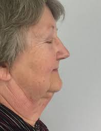 Mark Henley, MBChB, Specialist Registered Plastic Surgeon