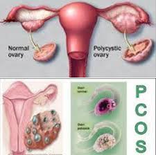 Confinement lady dan bekam wanita di bangi, kajang dan putrajaya | assalamualaikum dan salam sejahtera. Pcos Pada Wanita Dan Terapi Bekam Rumah Sehat Herba Holistic