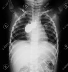 The main ranking factor for this coin is 24h change. X Ray Image Of Chest A Yong Boy With His Amulet Coin Stock Photo Picture And Royalty Free Image Image 40970984