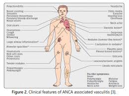 Image result for Microscopic Polyangiitis