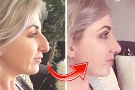 Find an option you need to apply and click on it. Nose Job Photo Editor For Android Apk Download
