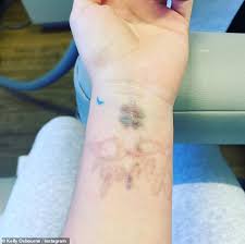 The short answer is that the risk to your baby's health with laser tattoo removal is low, with no research to suggest there's a risk. Kelly Osbourne Shares A Glimpse At Her Laser Tattoo Removal For Three Of Her Inks Aktuelle Boulevard Nachrichten Und Fotogalerien Zu Stars Sternchen