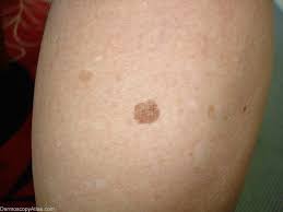 Image result for Solar Lentigo